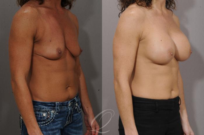 Breast Augmentation Case 1100 Before & After View #2 | Serving Rochester, Syracuse & Buffalo, NY | Quatela Center for Plastic Surgery