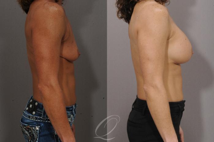 Breast Augmentation Case 1100 Before & After View #3 | Serving Rochester, Syracuse & Buffalo, NY | Quatela Center for Plastic Surgery