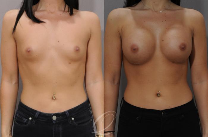 Breast Augmentation Case 1102 Before & After View #1 | Serving Rochester, Syracuse & Buffalo, NY | Quatela Center for Plastic Surgery