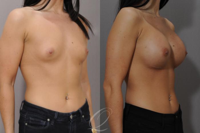 Breast Augmentation Case 1102 Before & After View #2 | Serving Rochester, Syracuse & Buffalo, NY | Quatela Center for Plastic Surgery