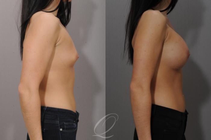 Breast Augmentation Case 1102 Before & After View #3 | Serving Rochester, Syracuse & Buffalo, NY | Quatela Center for Plastic Surgery