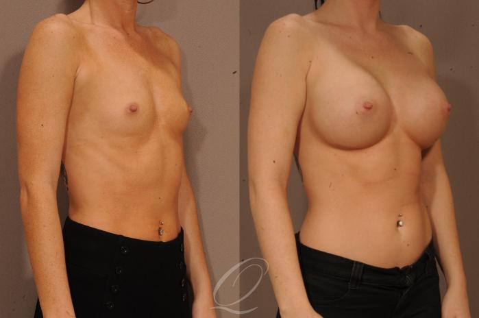 Breast Augmentation Case 1104 Before & After View #2 | Serving Rochester, Syracuse & Buffalo, NY | Quatela Center for Plastic Surgery