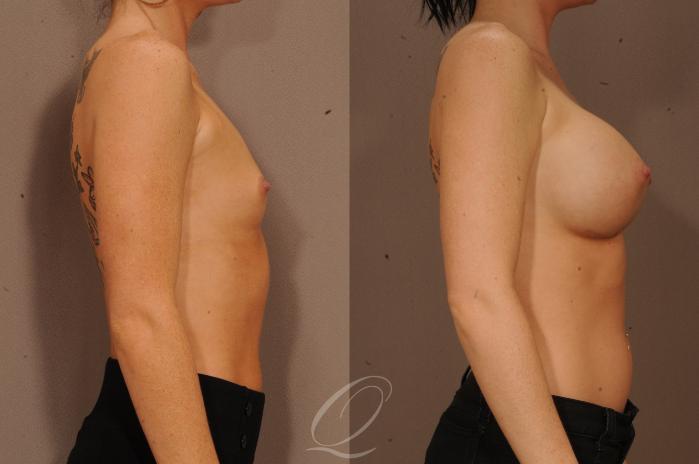 Breast Augmentation Case 1104 Before & After View #3 | Serving Rochester, Syracuse & Buffalo, NY | Quatela Center for Plastic Surgery