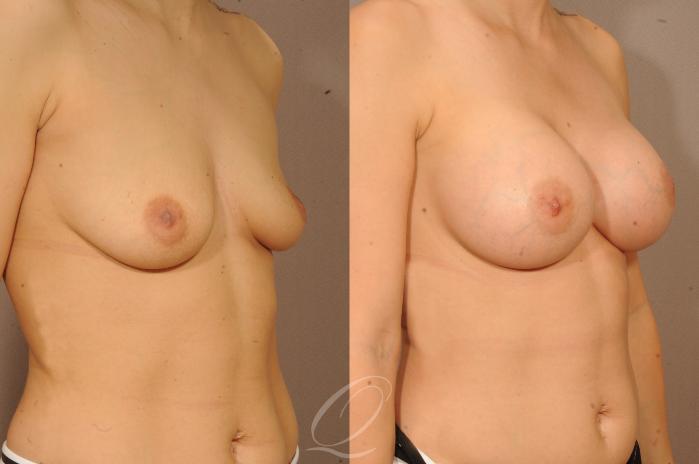 Breast Augmentation Case 1122 Before & After View #2 | Serving Rochester, Syracuse & Buffalo, NY | Quatela Center for Plastic Surgery