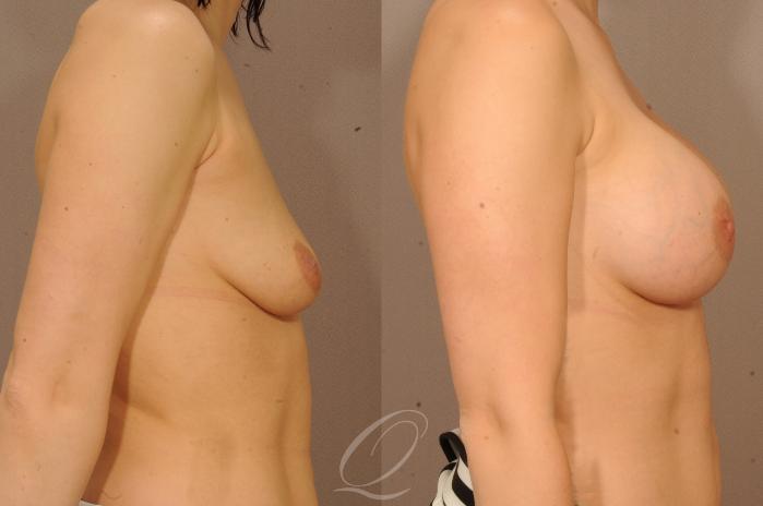 Breast Augmentation Case 1122 Before & After View #3 | Serving Rochester, Syracuse & Buffalo, NY | Quatela Center for Plastic Surgery