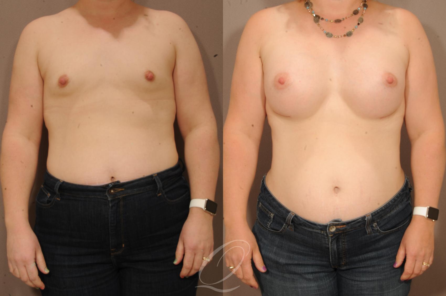 Breast Augmentation Case 1124 Before & After View #1 | Serving Rochester, Syracuse & Buffalo, NY | Quatela Center for Plastic Surgery