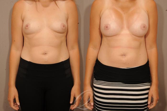 Breast Augmentation Case 1126 Before & After View #1 | Serving Rochester, Syracuse & Buffalo, NY | Quatela Center for Plastic Surgery
