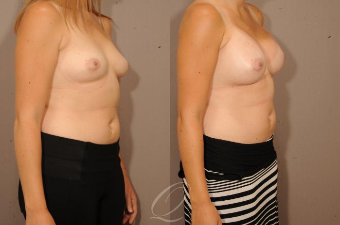 Breast Augmentation Case 1126 Before & After View #2 | Serving Rochester, Syracuse & Buffalo, NY | Quatela Center for Plastic Surgery