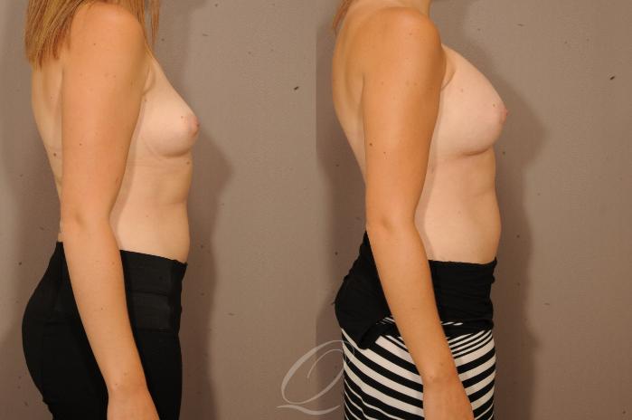 Breast Augmentation Case 1126 Before & After View #3 | Serving Rochester, Syracuse & Buffalo, NY | Quatela Center for Plastic Surgery