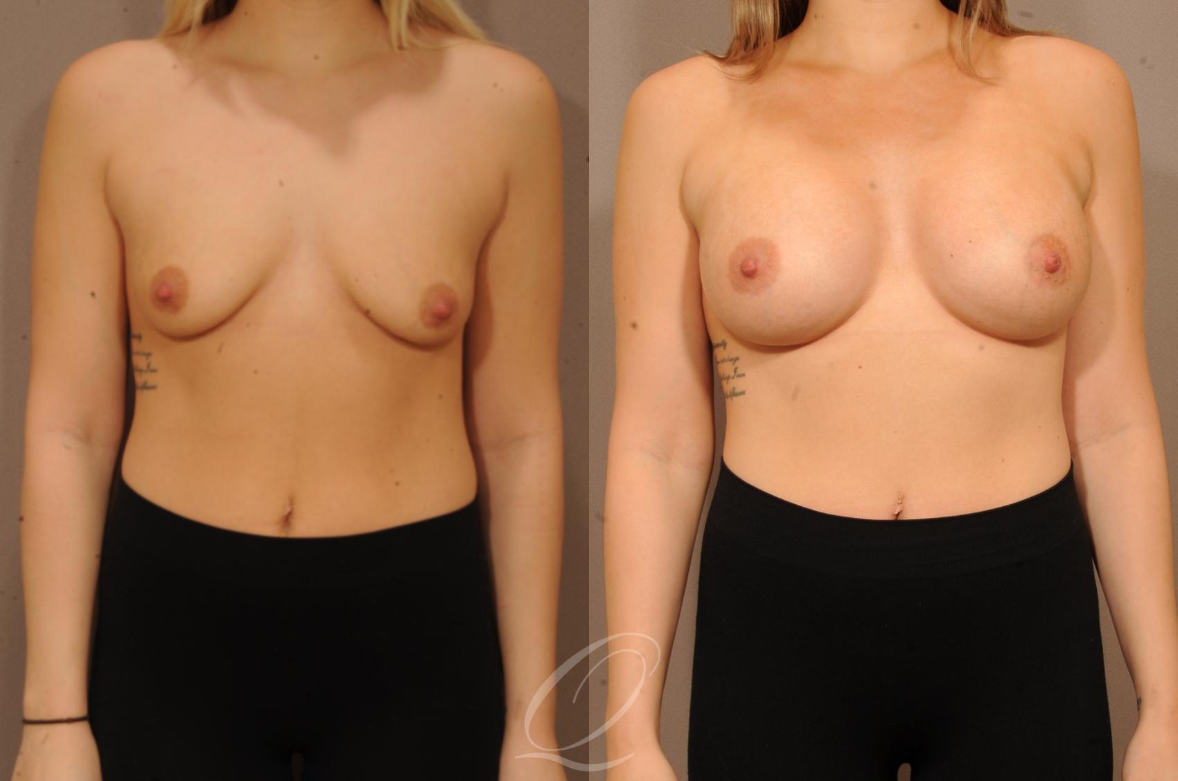 Breast Augmentation Case 1128 Before & After View #1 | Serving Rochester, Syracuse & Buffalo, NY | Quatela Center for Plastic Surgery