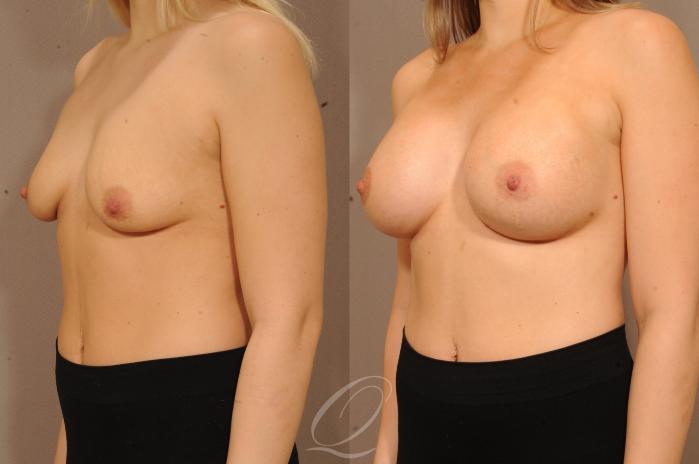 Breast Augmentation Case 1128 Before & After View #2 | Serving Rochester, Syracuse & Buffalo, NY | Quatela Center for Plastic Surgery