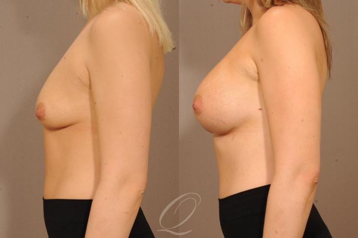 Breast Augmentation Case 1128 Before & After View #3 | Serving Rochester, Syracuse & Buffalo, NY | Quatela Center for Plastic Surgery