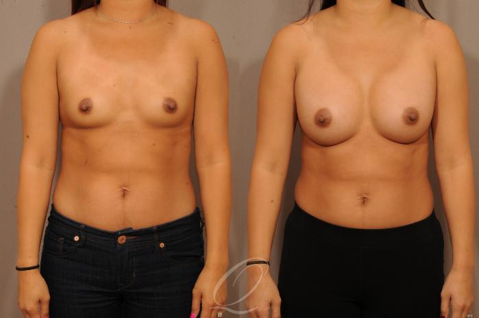 Breast Augmentation Case 1149 Before & After View #1 | Serving Rochester, Syracuse & Buffalo, NY | Quatela Center for Plastic Surgery