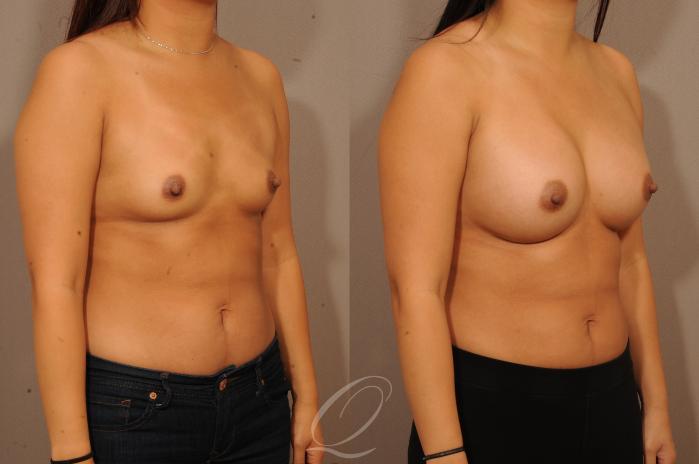 Breast Augmentation Case 1149 Before & After View #2 | Serving Rochester, Syracuse & Buffalo, NY | Quatela Center for Plastic Surgery