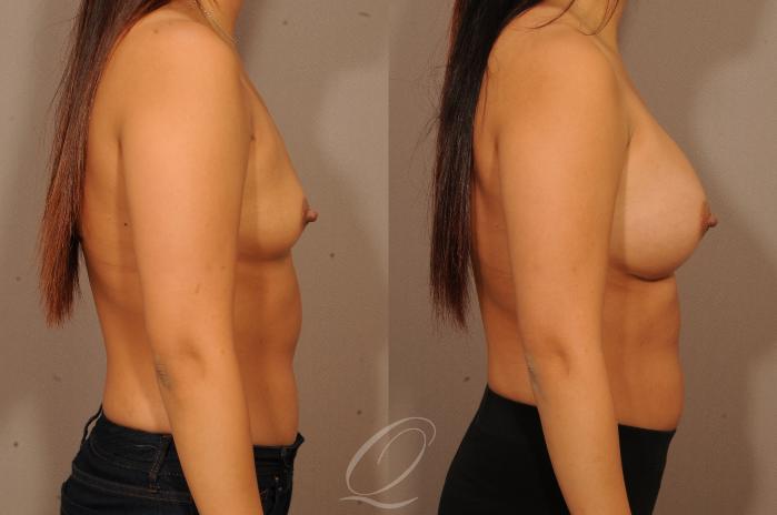 Breast Augmentation Case 1149 Before & After View #3 | Serving Rochester, Syracuse & Buffalo, NY | Quatela Center for Plastic Surgery