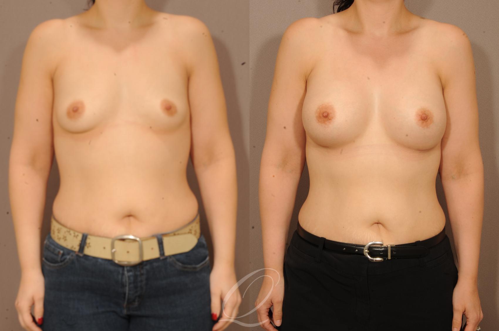 Breast Augmentation Case 1228 Before & After View #1 | Serving Rochester, Syracuse & Buffalo, NY | Quatela Center for Plastic Surgery