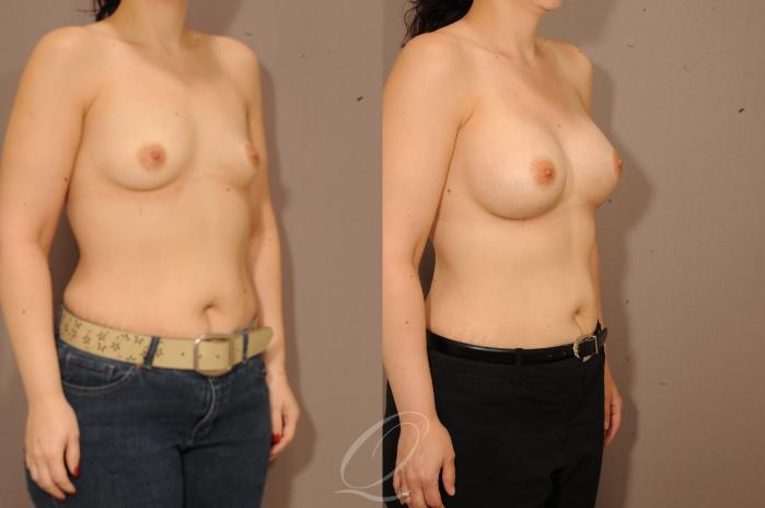 Breast Augmentation Case 1228 Before & After View #2 | Serving Rochester, Syracuse & Buffalo, NY | Quatela Center for Plastic Surgery
