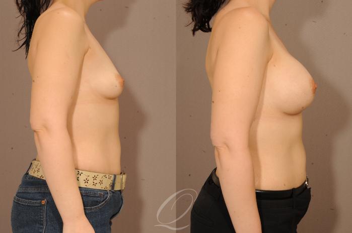 Breast Augmentation Case 1228 Before & After View #3 | Serving Rochester, Syracuse & Buffalo, NY | Quatela Center for Plastic Surgery