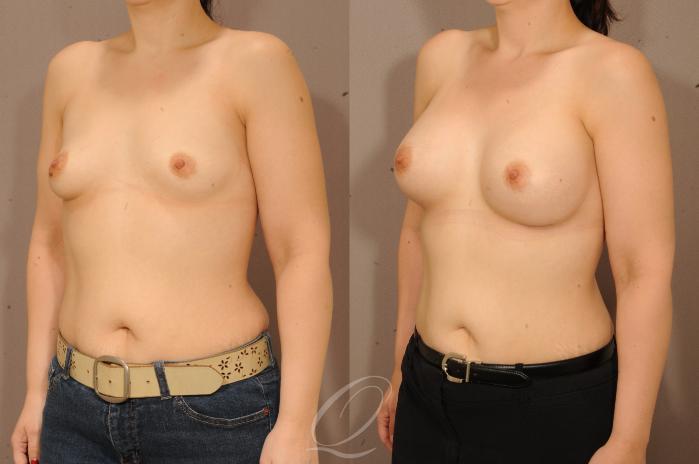 Breast Augmentation Case 1228 Before & After View #4 | Serving Rochester, Syracuse & Buffalo, NY | Quatela Center for Plastic Surgery