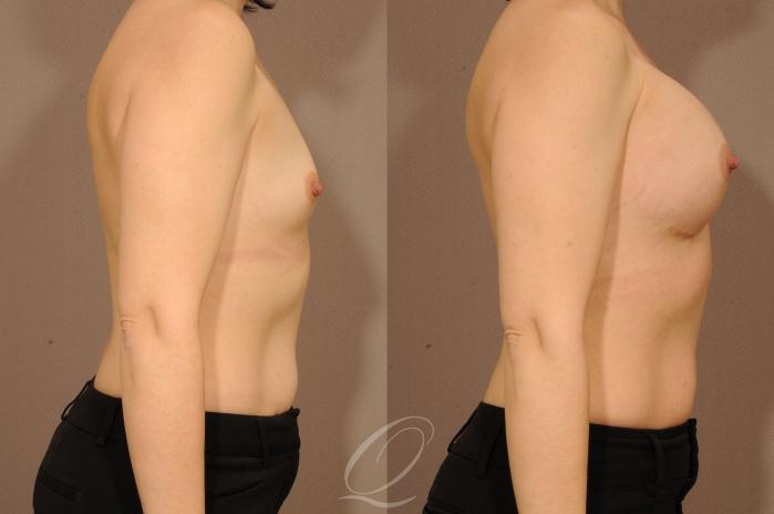 Breast Augmentation Case 1229 Before & After View #3 | Serving Rochester, Syracuse & Buffalo, NY | Quatela Center for Plastic Surgery