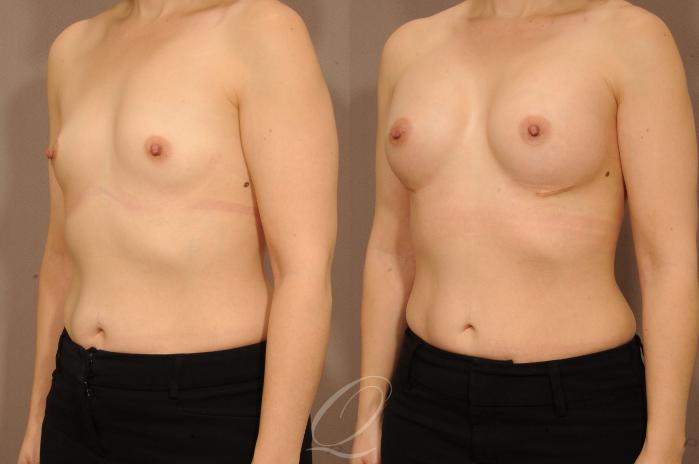 Breast Augmentation Case 1229 Before & After View #4 | Serving Rochester, Syracuse & Buffalo, NY | Quatela Center for Plastic Surgery