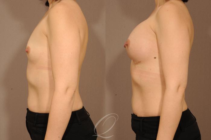 Breast Augmentation Case 1229 Before & After View #5 | Serving Rochester, Syracuse & Buffalo, NY | Quatela Center for Plastic Surgery