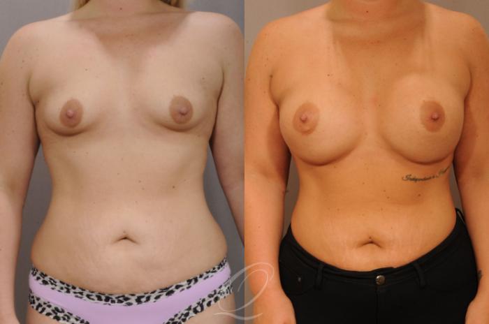 Breast Augmentation Case 1231 Before & After View #1 | Serving Rochester, Syracuse & Buffalo, NY | Quatela Center for Plastic Surgery