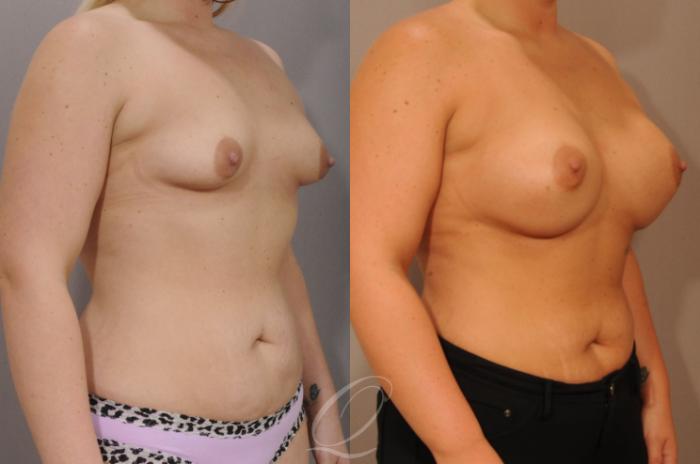 Breast Augmentation Case 1231 Before & After View #2 | Serving Rochester, Syracuse & Buffalo, NY | Quatela Center for Plastic Surgery