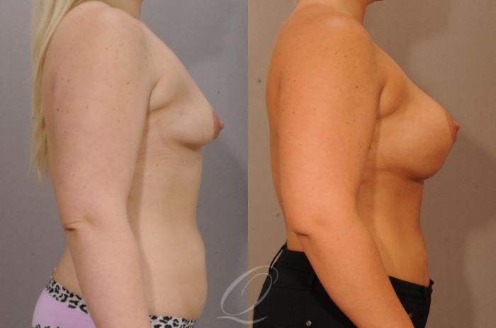Breast Augmentation Case 1231 Before & After View #3 | Serving Rochester, Syracuse & Buffalo, NY | Quatela Center for Plastic Surgery