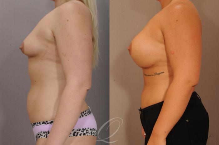 Breast Augmentation Case 1231 Before & After View #5 | Serving Rochester, Syracuse & Buffalo, NY | Quatela Center for Plastic Surgery