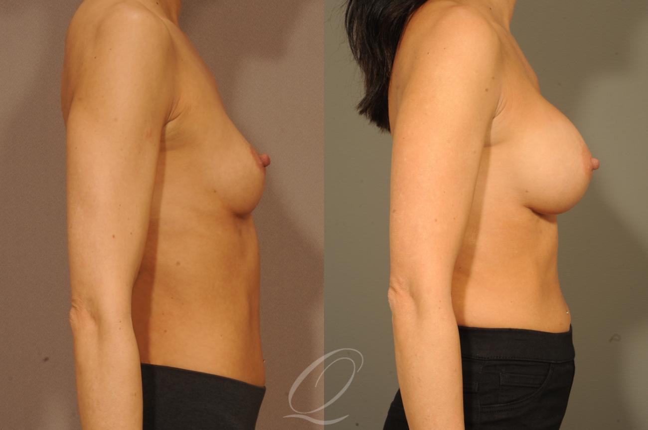 Breast Augmentation Case 1300 Before & After View #3 | Serving Rochester, Syracuse & Buffalo, NY | Quatela Center for Plastic Surgery