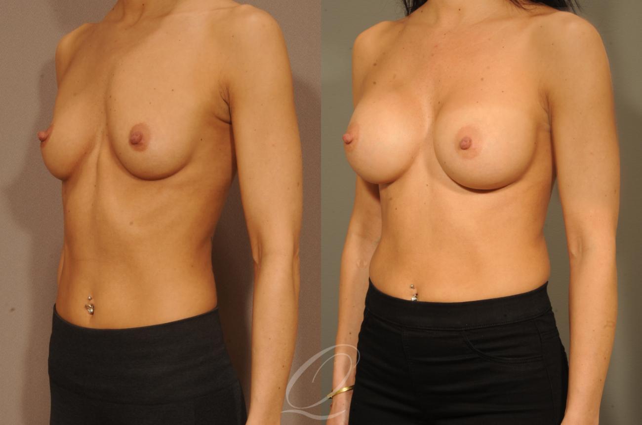 Breast Augmentation Case 1300 Before & After View #4 | Serving Rochester, Syracuse & Buffalo, NY | Quatela Center for Plastic Surgery