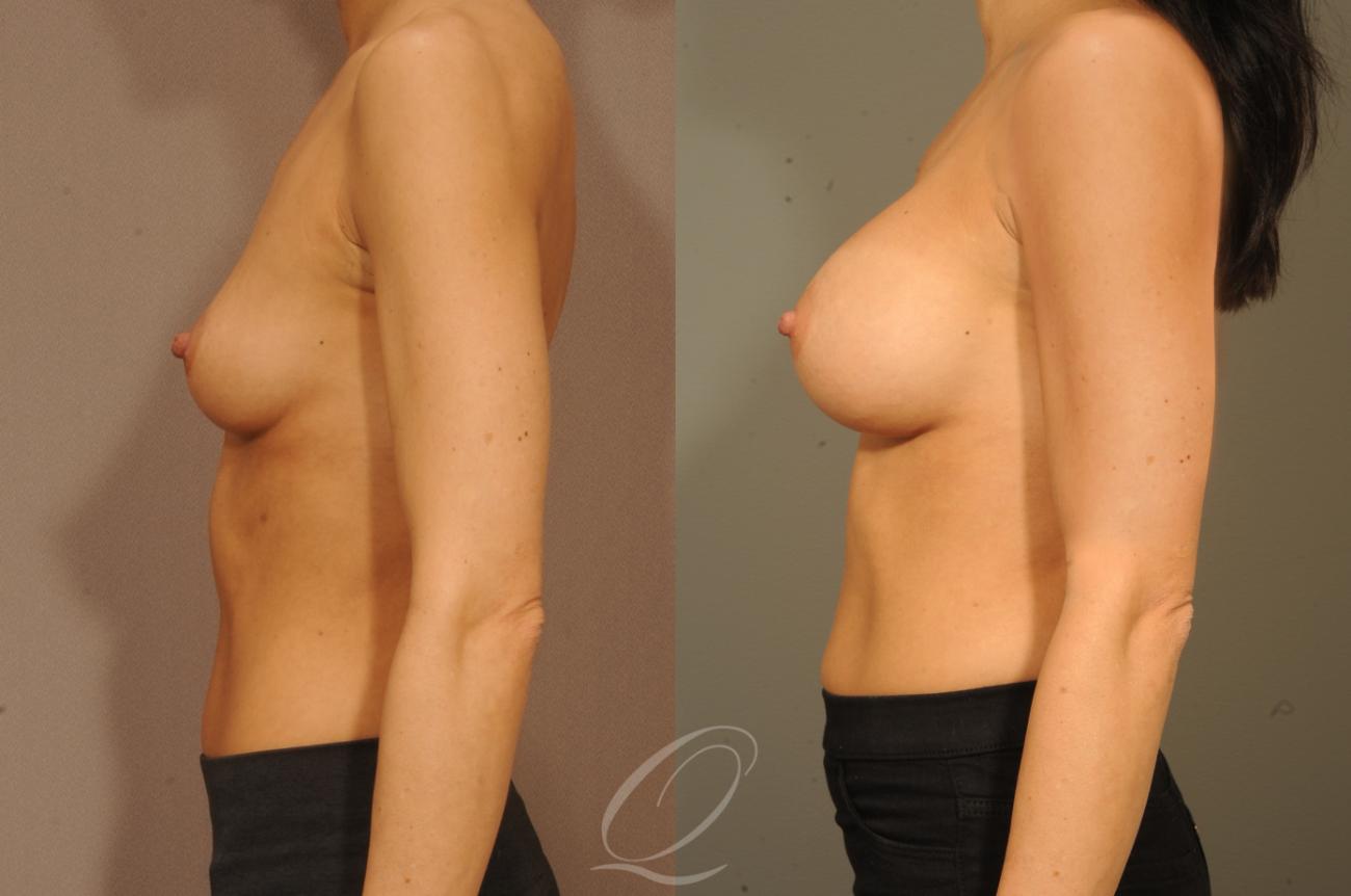 Breast Augmentation Case 1300 Before & After View #5 | Serving Rochester, Syracuse & Buffalo, NY | Quatela Center for Plastic Surgery