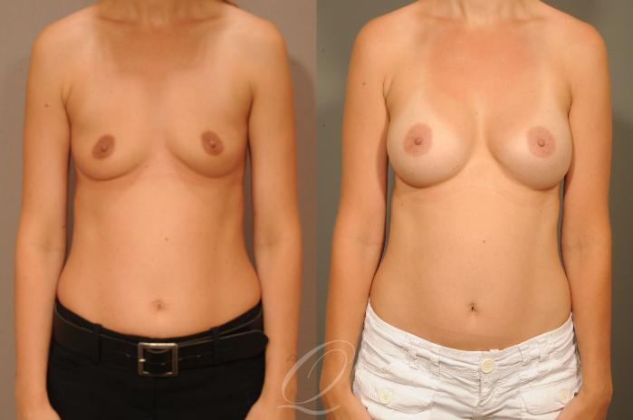 Breast Augmentation Case 1331 Before & After View #1 | Serving Rochester, Syracuse & Buffalo, NY | Quatela Center for Plastic Surgery