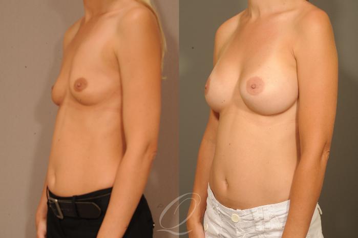 Breast Augmentation Case 1331 Before & After View #2 | Serving Rochester, Syracuse & Buffalo, NY | Quatela Center for Plastic Surgery
