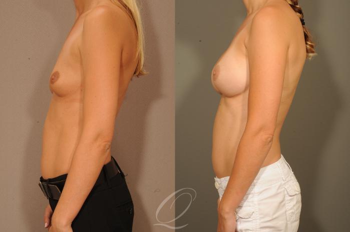 Breast Augmentation Case 1331 Before & After View #3 | Serving Rochester, Syracuse & Buffalo, NY | Quatela Center for Plastic Surgery