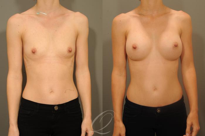 Breast Augmentation Case 1336 Before & After View #1 | Serving Rochester, Syracuse & Buffalo, NY | Quatela Center for Plastic Surgery