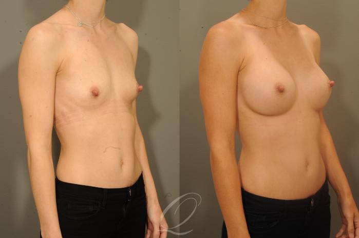 Breast Augmentation Case 1336 Before & After View #2 | Serving Rochester, Syracuse & Buffalo, NY | Quatela Center for Plastic Surgery