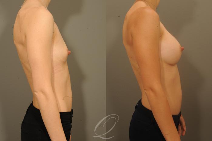 Breast Augmentation Case 1336 Before & After View #3 | Serving Rochester, Syracuse & Buffalo, NY | Quatela Center for Plastic Surgery