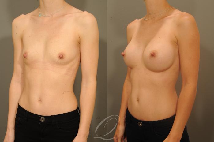 Breast Augmentation Case 1336 Before & After View #4 | Serving Rochester, Syracuse & Buffalo, NY | Quatela Center for Plastic Surgery