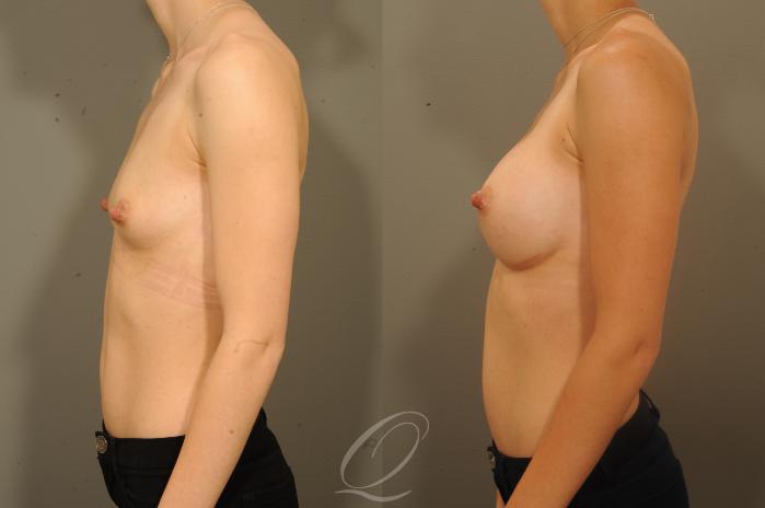 Breast Augmentation Case 1336 Before & After View #5 | Serving Rochester, Syracuse & Buffalo, NY | Quatela Center for Plastic Surgery