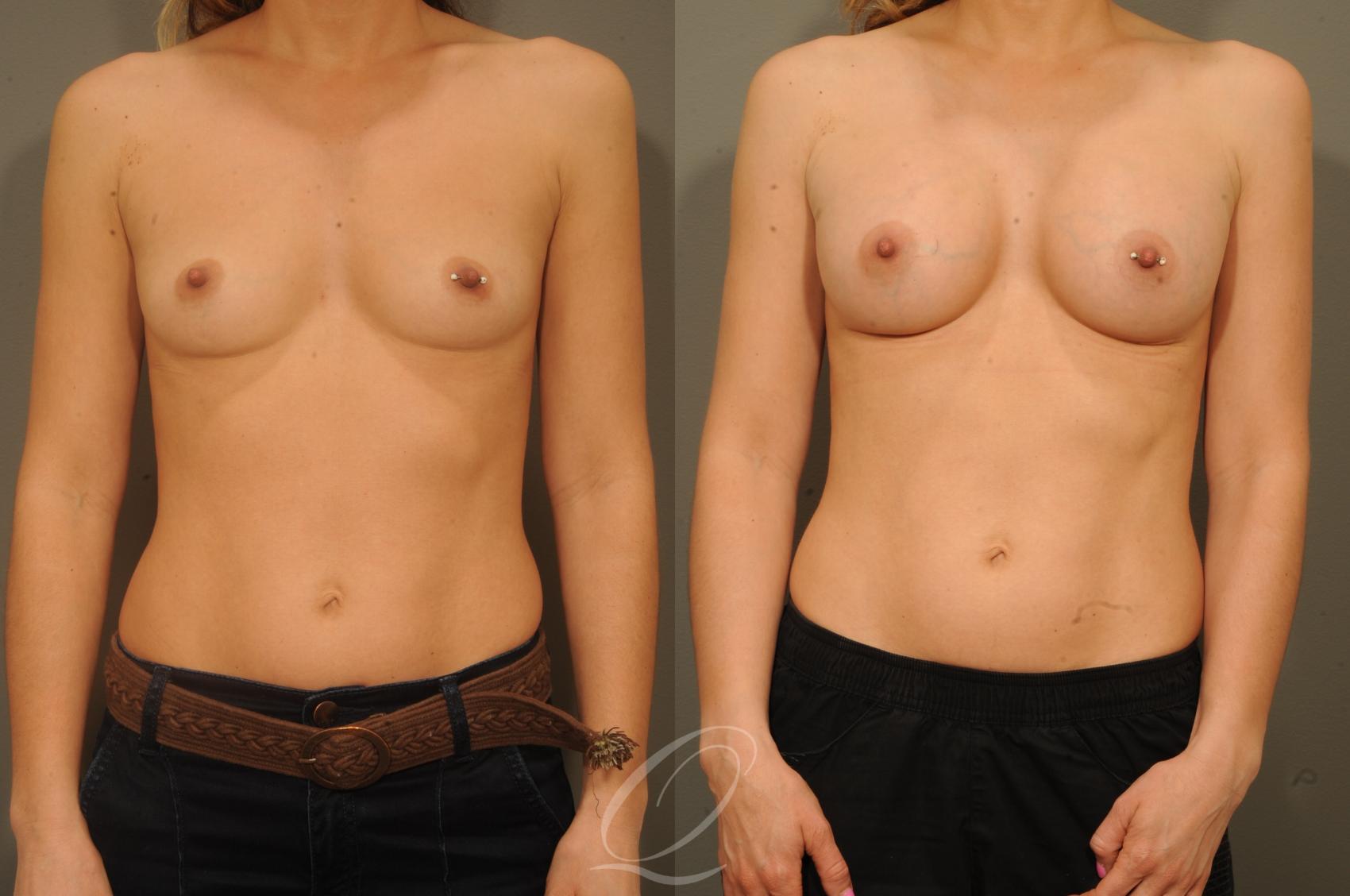 Breast Augmentation Case 1337 Before & After View #1 | Serving Rochester, Syracuse & Buffalo, NY | Quatela Center for Plastic Surgery