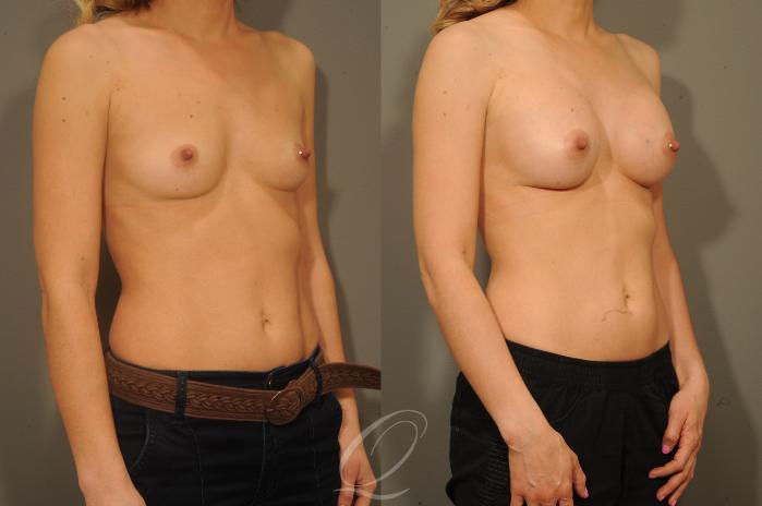 Breast Augmentation Case 1337 Before & After View #2 | Serving Rochester, Syracuse & Buffalo, NY | Quatela Center for Plastic Surgery