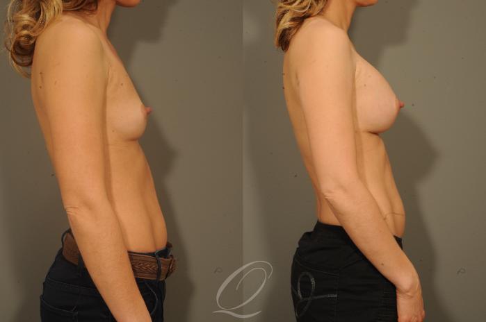 Breast Augmentation Case 1337 Before & After View #3 | Serving Rochester, Syracuse & Buffalo, NY | Quatela Center for Plastic Surgery