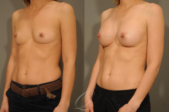 Breast Augmentation Case 1337 Before & After View #4 | Serving Rochester, Syracuse & Buffalo, NY | Quatela Center for Plastic Surgery