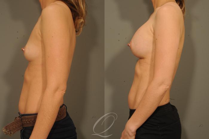 Breast Augmentation Case 1337 Before & After View #5 | Serving Rochester, Syracuse & Buffalo, NY | Quatela Center for Plastic Surgery