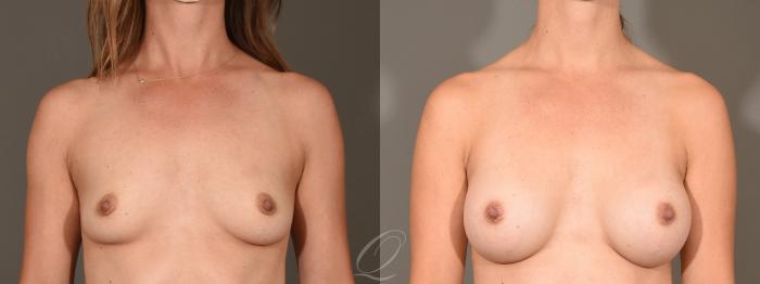 Breast Augmentation Case 1351 Before & After Front | Serving Rochester, Syracuse & Buffalo, NY | Quatela Center for Plastic Surgery