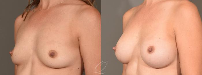 Breast Augmentation Case 1351 Before & After Left Oblique | Serving Rochester, Syracuse & Buffalo, NY | Quatela Center for Plastic Surgery
