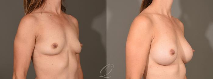 Breast Augmentation Case 1351 Before & After Right Oblique | Serving Rochester, Syracuse & Buffalo, NY | Quatela Center for Plastic Surgery