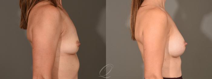 Breast Augmentation Case 1351 Before & After Right Side | Serving Rochester, Syracuse & Buffalo, NY | Quatela Center for Plastic Surgery